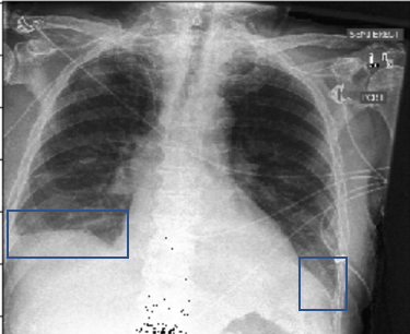 chest-x-ray